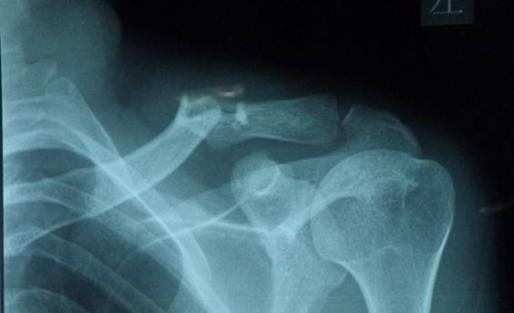创伤外科成功实施微创粉碎性骨折内固定术