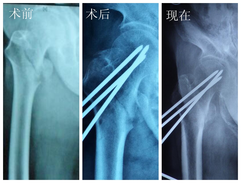 四川护理职业学院附属医院成功为一名88岁高龄患者实施骨折手术